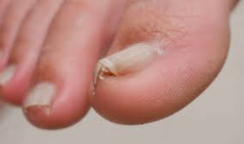 Early ingrown toenails